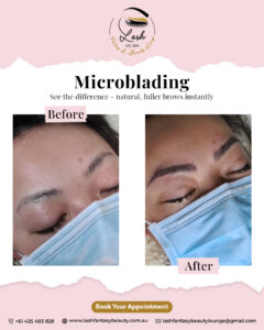 microneedling in tarneit