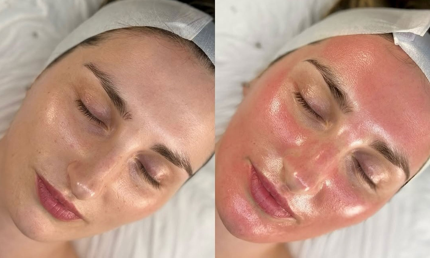 Microneedling in Werribee