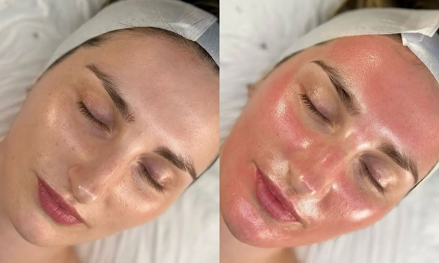 Professional microneedling treatment application - skin rejuvenation procedure in Werribee salon