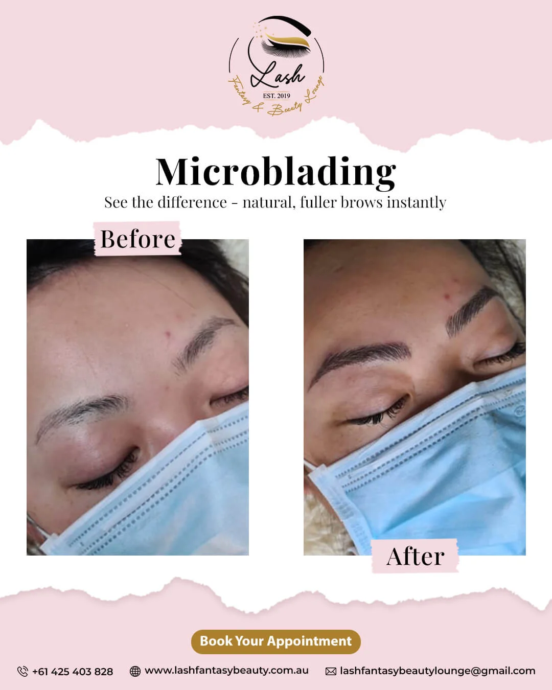 Professional microneedling treatment in Hoppers Crossing - skin rejuvenation collagen induction therapy